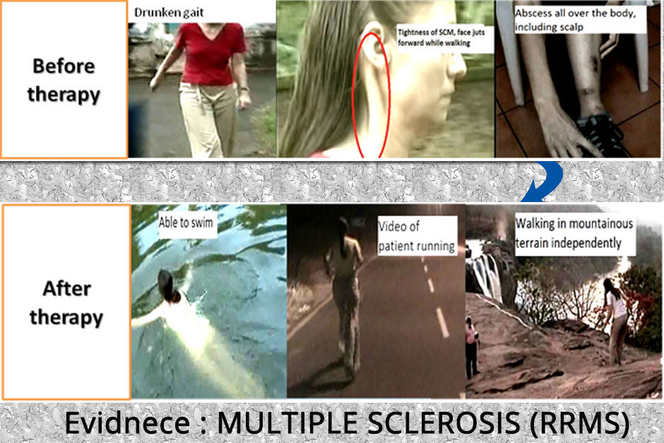 MULTIPLE SCLEROSIS (RRMS)